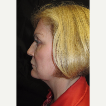 55-64 year old woman treated with Facelift before 3088493