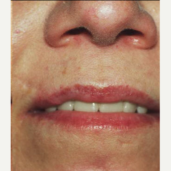 45-54 year old woman treated with Scar Removal after 3725571