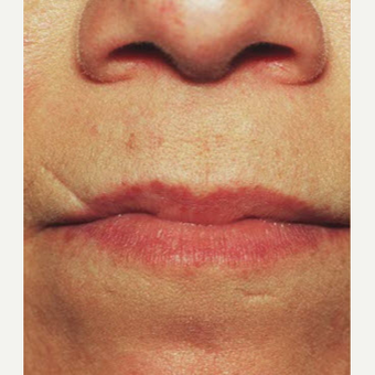 45-54 year old woman treated with Scar Removal before 3725571
