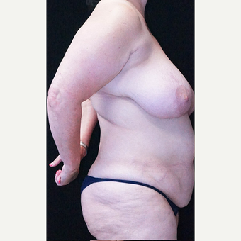 Breast Reduction before 3332866