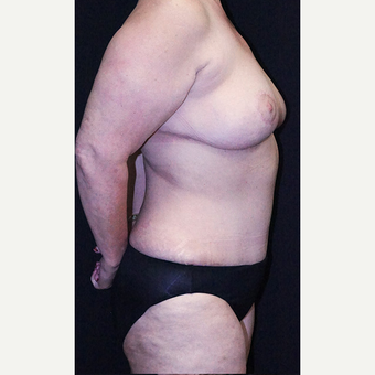 Breast Reduction after 3332866