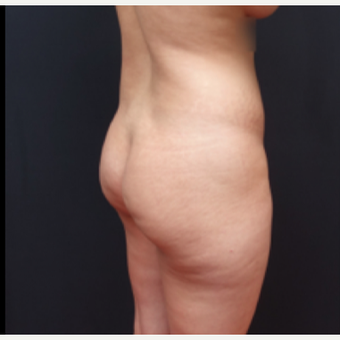 25-34 year old woman treated with Liposculpture before 3267097