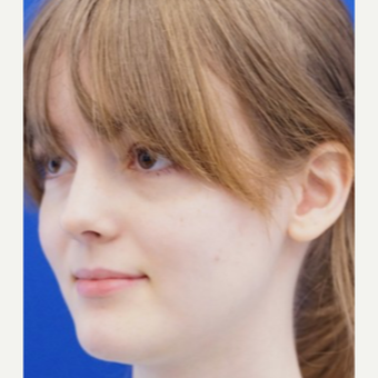 18-24 year old woman treated with Revision Rhinoplasty after 3678818