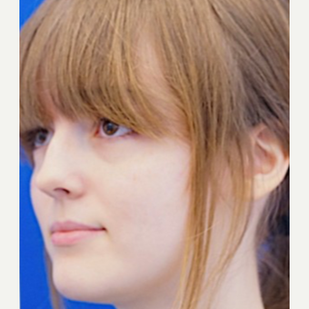 18-24 year old woman treated with Revision Rhinoplasty before 3678818
