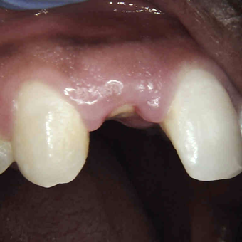 25-34 year old man treated with Dental Crown before 3168464