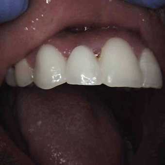25-34 year old man treated with Dental Crown after 3168464