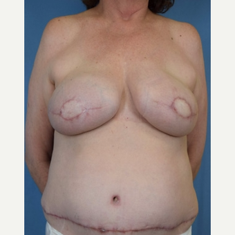 55-64 year old woman treated with Breast Reconstruction after 3644551