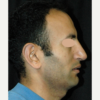 35-44 year old man treated with Rhinoplasty after 3783328