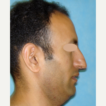 35-44 year old man treated with Rhinoplasty before 3783328
