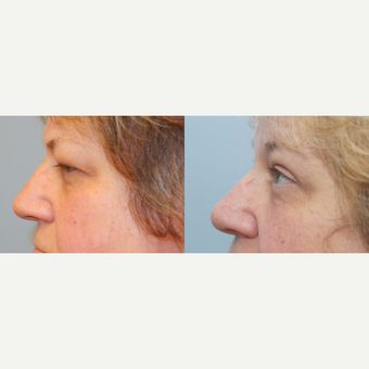 56 yr old Female - Eyelid Surgery after 3099773