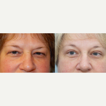 56 yr old Female - Eyelid Surgery before 3099773