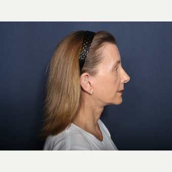 55-64 year old woman treated with Neck Lift (view 2 of 2) after 3226126