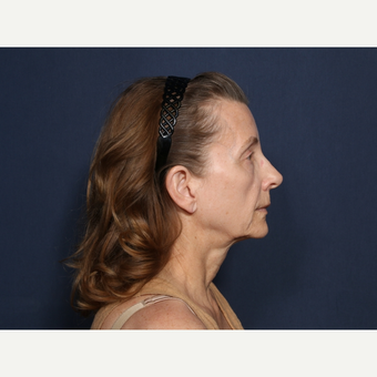 55-64 year old woman treated with Neck Lift (view 2 of 2) before 3226126