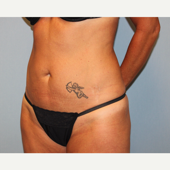 35-44 year old woman treated with Tummy Tuck before 3815705