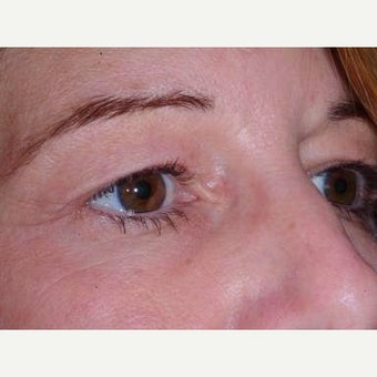 35-44 year old woman treated with Eyelid Surgery before 2197889