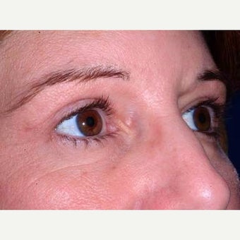 35-44 year old woman treated with Eyelid Surgery after 2197889