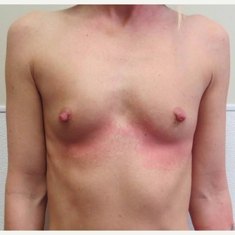 Anatomically Shaped Breast Implants for this 35 Year Old Woman before 2985386