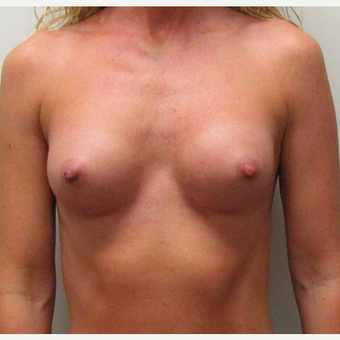 Anatomically Shaped Breast Implants for this 35 Year Old Woman after 2985386