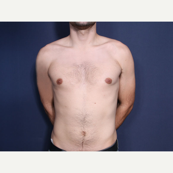 25-34 year old man treated with Male Breast Reduction after 3658759