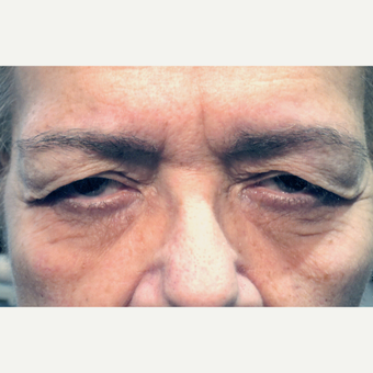65-74 year old woman treated with Blapharoplasty Eyelid Surgery before 3180182