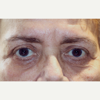 65-74 year old woman treated with Blapharoplasty Eyelid Surgery after 3180182