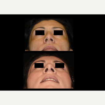 25-34 year old woman treated with Rhinoplasty before 3680398
