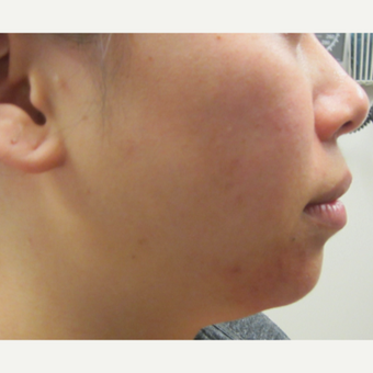 28 year old woman treated with Perlane in chin before 3121319