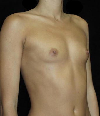 30 year old woman treated with Breast Augmentation 3802738