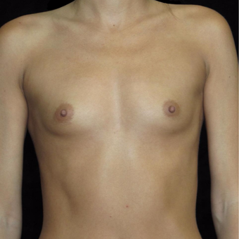 30 year old woman treated with Breast Augmentation before 3802738
