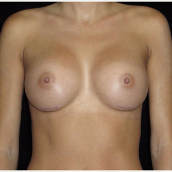 30 year old woman treated with Breast Augmentation after 3802738
