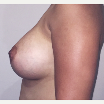 22 Year Old - Dual Plane Breast Augmentation after 3583338
