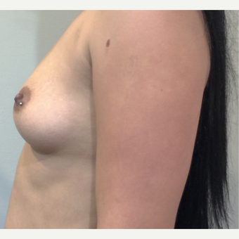 22 Year Old - Dual Plane Breast Augmentation before 3583338