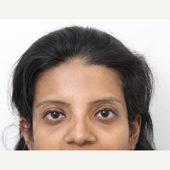 25-34 year old woman treated with Rhinoplasty after 3424447