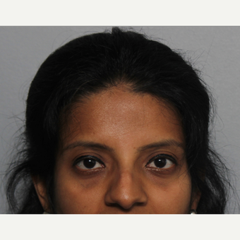 25-34 year old woman treated with Rhinoplasty before 3424447