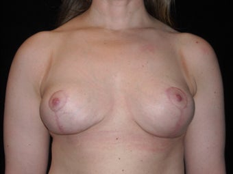 Breast implant removal and breast lift in 39 year old after 955382