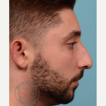 25-34 year old man treated with open Septoplasty/revision rhinoplasty before 3108876