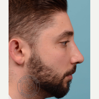 25-34 year old man treated with open Septoplasty/revision rhinoplasty after 3108876