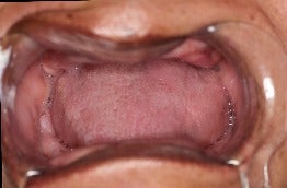35-44 year old woman treated with Dental Implants before 3220827