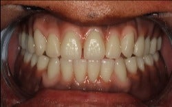 35-44 year old woman treated with Dental Implants after 3220827
