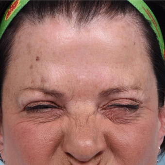 64 year old woman treated with Dysport after 3094408