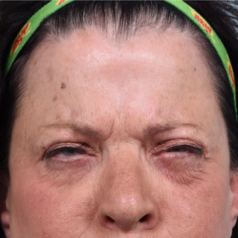 64 year old woman treated with Dysport before 3094408