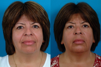 51-year-old woman treated with Restylane™. before 574581