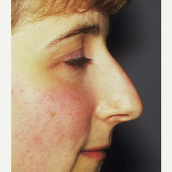 25-34 year old woman treated with Rhinoplasty before 3711559