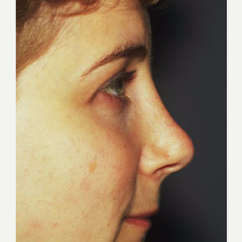 25-34 year old woman treated with Rhinoplasty after 3711559