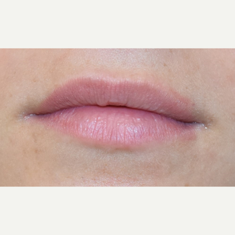 18-24 year old woman treated with Juvederm before 3749619
