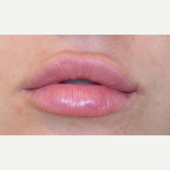 18-24 year old woman treated with Juvederm after 3749619