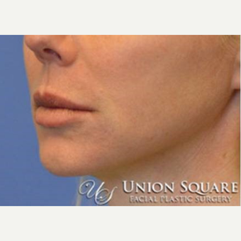 Lip lift performed under local anesthesia before 3489572