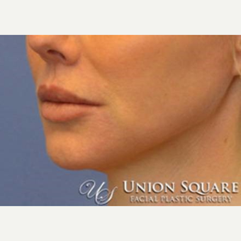 Lip lift performed under local anesthesia after 3489572
