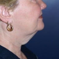 55-64 year old woman treated with Neck Lift before 1564023