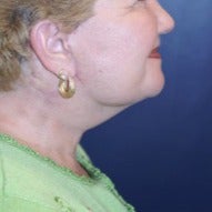 55-64 year old woman treated with Neck Lift after 1564023